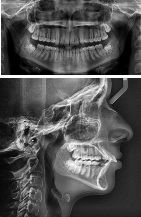  The OPG and ceph radiograph of our patient