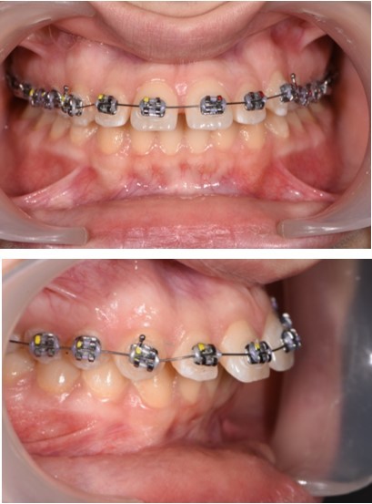  Treatment start - Orthodontic appliance on the upper arch, Roth 022" prescription.