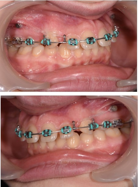  Retraction of the upper incisors with elastics chains placed from crimpable hooks to orthodontic implants.