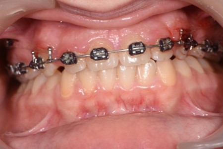  Significant overjet and overbite improvement after implant based orthodontic retraction.