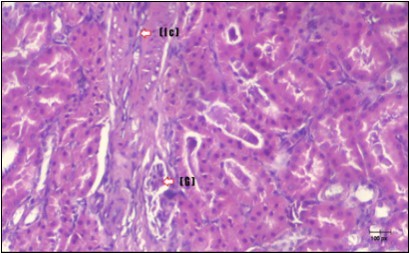  Photomicrogragh of kidney section of diabetic rat showing a trophy of Bowman,s  capsules and damage of glomeruli  (arrow) and damage of distal and proximal tubules with congested blood vessels (star) . (H&E) (100Px).