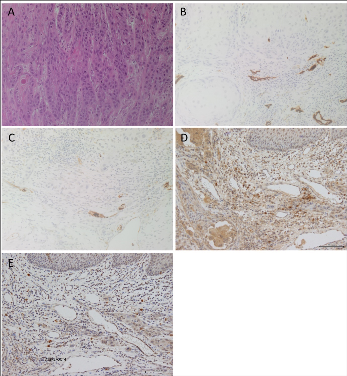  A representative H&E stain of an oral tongue squamous cell carcinoma (OTSCC) showing the presence of the tumor (A). Representative images of OTSCC stained positively for CD34 (B, brown), ACE (C, brown), ATIIR1 (D, brown) and ATIIR2 (E, brown). Nuclei were counterstained with hematoxylin (blue). Orignial magnification 200X.