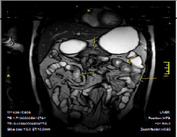  Heterogeneous bowel wall and mucosa involvement with collaborating skip lesions, specific for Crohn’s disease, predominant in ileum and terminal ileum which are shown at T2W coronal sequence after OCA, regarded at 39 years old female with severe disease.