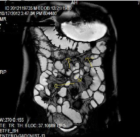  Mucosal involvement and lack of opacified ileal segments with loss of intestinal folds and increased bowel wall thickness due to Crohn’s disease on T2W coronal sequence after OCA, presented at 37 years old male with moderate Crohn’s disease.