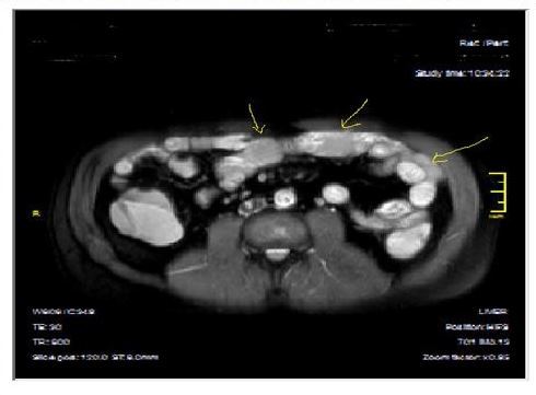  Mucosal, luminal and bowel wall involvement in Crohn’s disease with skipped lesions, seen at T2W axial image after OCA,  presented at 45 years old male with severe inflammatory disease.