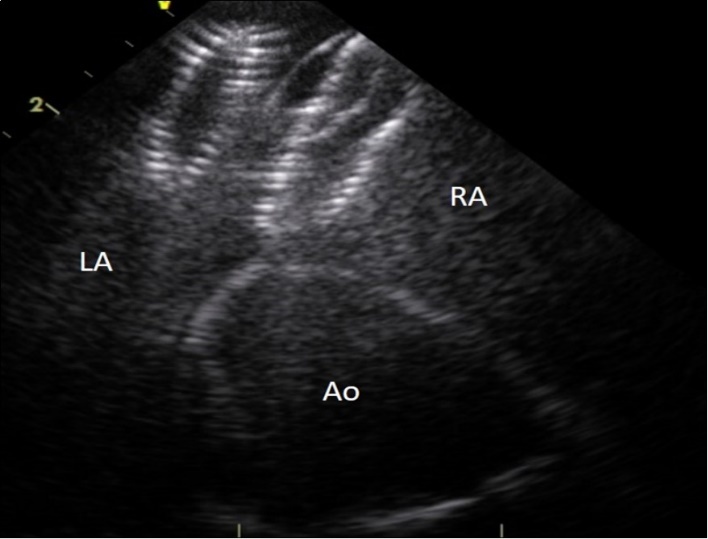  Entraped Amplatzer ASD closure device in the left ventricular outflow tract. LA : left atrium, AO : aorta, arrow : ASD closure device.