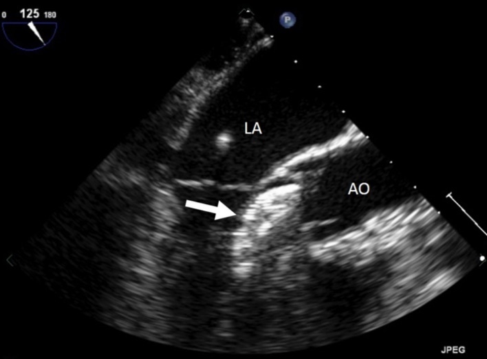  Intracardiac ultrasound picture of the ASD Amplatzer device in place on the interatrial septum. RA :right atrium. LA:left atrium. Ao :aorta