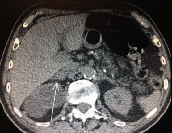  CT scan showing isolated right adrenal NSLC metastasis (Arrow)