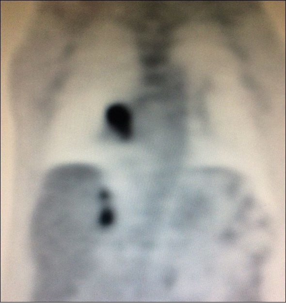  PET CT showing simultaneous uptake on right lung mass and 2 ipsilateral adrenal nodules.