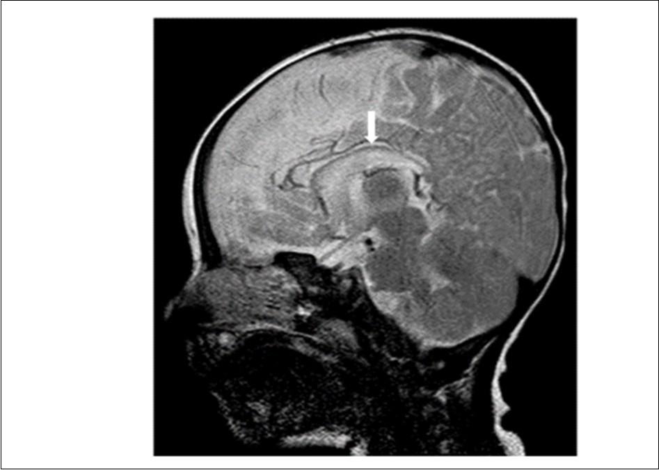  Midline sagittal T2-weighted magnetic resonance image of the patient showing diffuse hypoplasia of the corpus callosum.