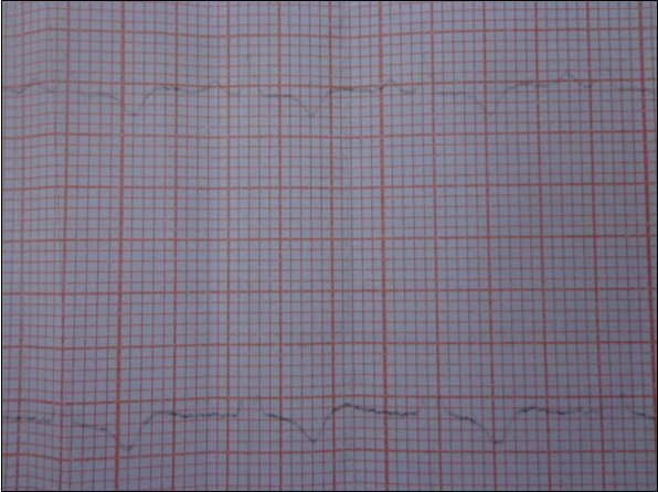  Electrocardiogram: epicardial ischemia in the     infero-lateral territory.