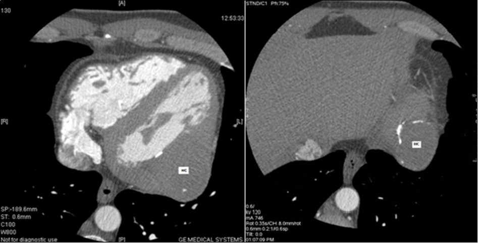  Coroscanner: left ventricle intra-myocardial mass of parenchymal density and calcified wall (HC: hydatid cyst).