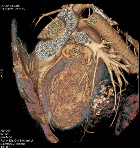  Coroscanner with three-dimensional                 reconstruction: intra-myocardial mass of left                  ventricle with multiple calcifications.