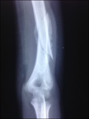 Partially united and angulated humerus shaft fracture          prior to LLLT administration in one patient