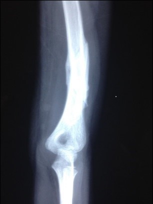  Same patient after LLLT administration. Notice the               fracture ends re-modelled nicely and fracture had solidly healed