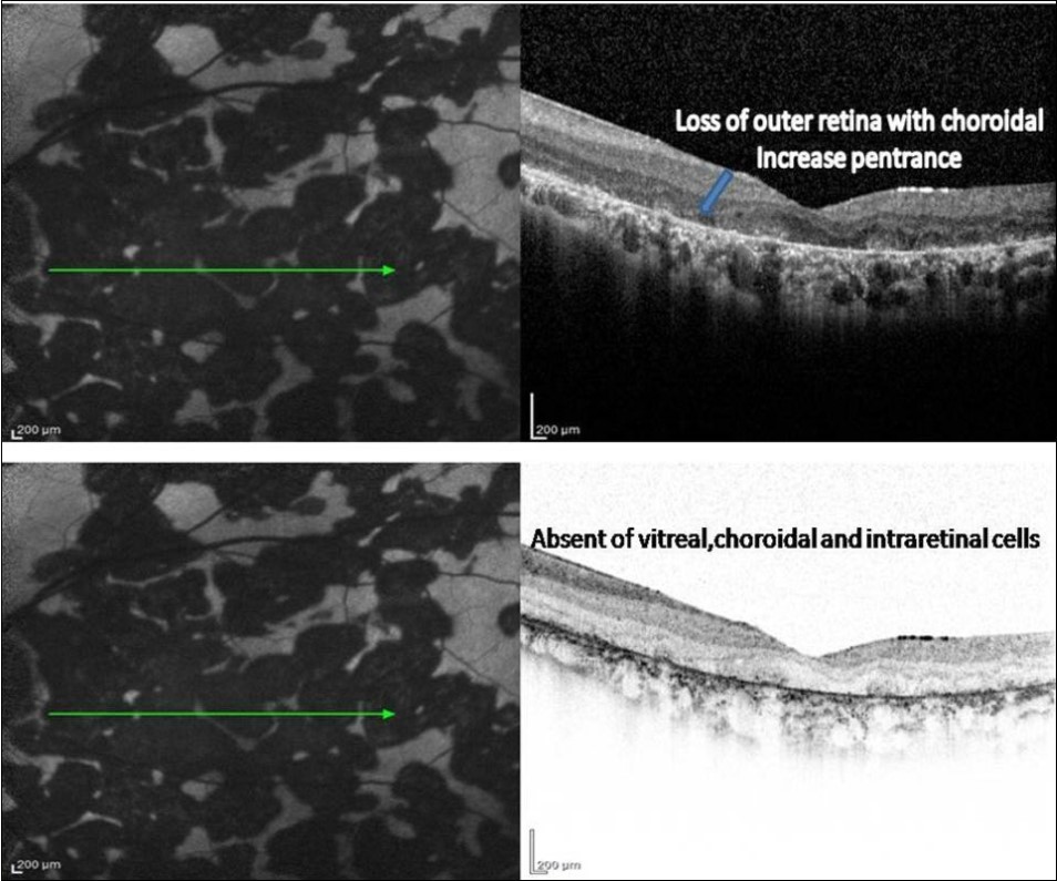  FAF (left) and corresponding eye-tracked SD-OCT image (right) of patient 1 healed stage of the left eye shows showed loss of RPE, POST, IS/OS junction, and ELM with increased reflectance from the choroidal layers. absent of the choroidal and intraretinal cells.