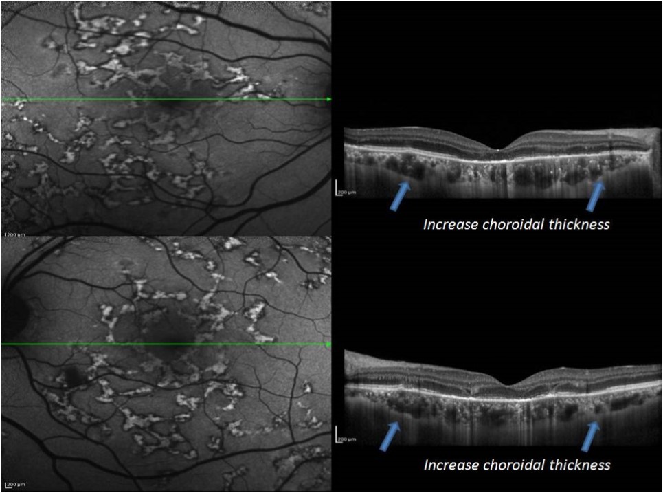  EDI-OCT in acute stage of MSC reveled increase choroidal thickness