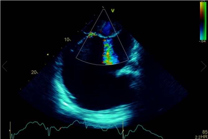  Transthoracic echocardiogram Apical 4C view. Findings      include severely enlarged left atrium, severe mitral stenosis with                  associated regurgitation, a mean gradient across the valve of 11mmHg with a hyperdynamic left ventricle