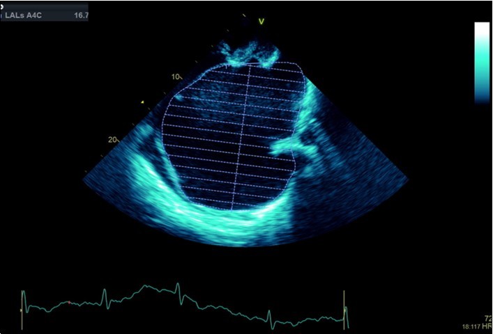  Transthoracic echocardiogram Apical 4C view. Left atrial size estimation by Simpson’s biplane method from apical 4C view.