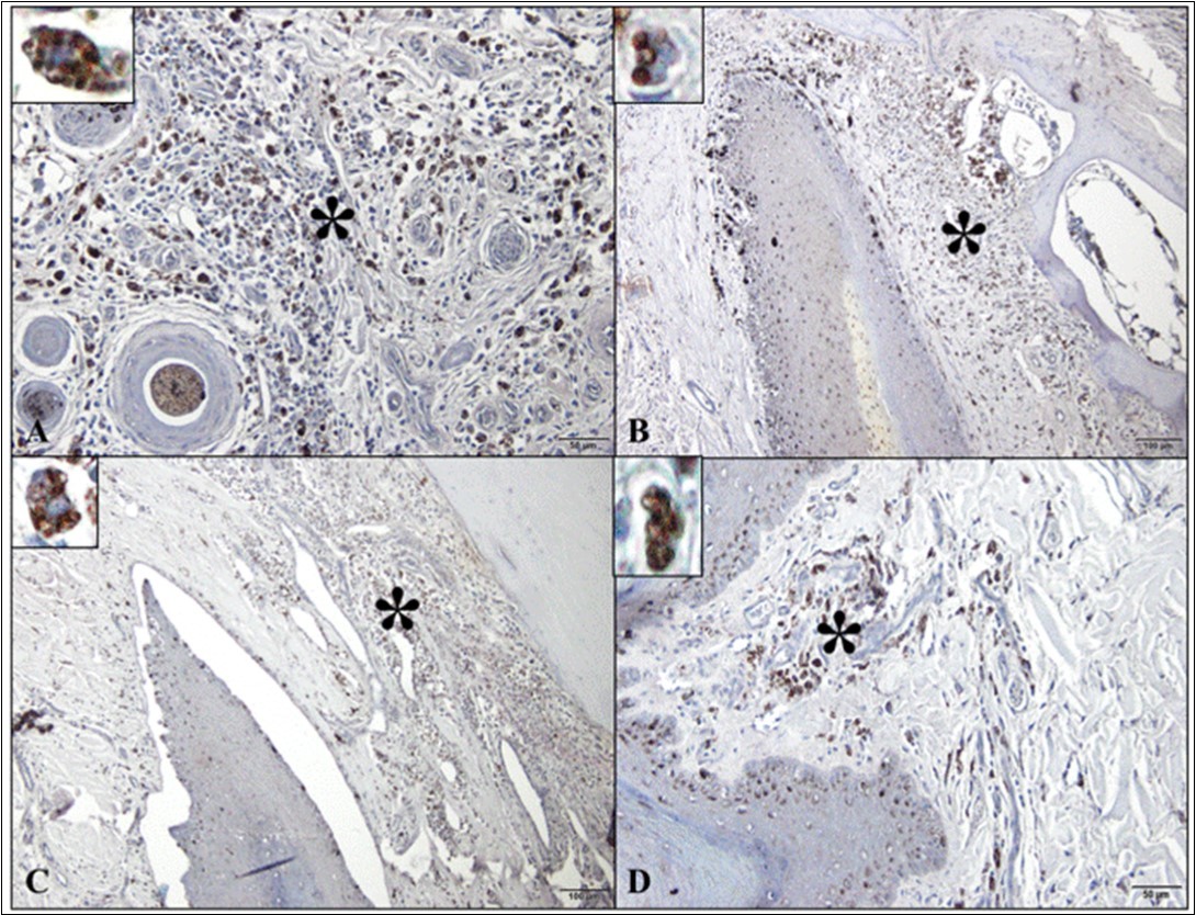  Photomicrographs of Leishmania infantum amastigote immunomarkers in the digit of dogs with visceral leishmaniasis. (A) Note the detection of parasite in the macrophage cytoplasm in the dorsal epidermis/dermis (*; detail; bar=50µm). (B) Parasitized macrophages in the dorsal matrix/dermis (*; detail; bar=100µm). (C) Presence of parasite in the ventral matrix/dermis (*; detail; bar=100µm). (D) Infection with parasitized macrophages in ventral epidermis/dermis (footpad) (*; detail; bar=100µm). Peroxidase-bound polymer complex.