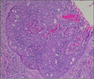  Aberrant and malignant                 epithelium  with cellular proliferation and pleomorphism in eccrine                   porocarcinoma with frequent mitosis(19).