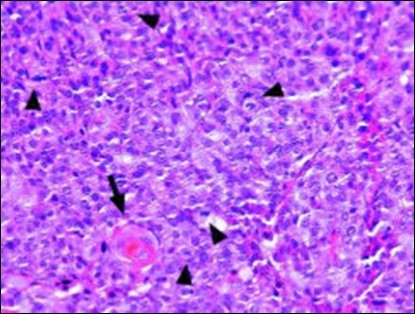  Disseminated  atypical  epithelial cells with cellular and nuclear                          pleomorphism, hyperchromasia, indistinct cytoplasm, vesicular nucleoli   and central keratinization in eccrine porocarcinoma(20).