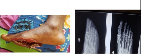  Open fracture of the shafts of the right 2nd, 3rd ,4th and 5th metatarsals, treated by normal saline                      irrigation, debridement and kirchner wire stabilisation.