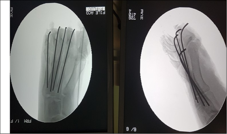  Check x-rays, anteroposterior and lateral views of the open right                     metatarsal fracture in figure 1, showing stabilization with 2.0-mm kirchner wires.