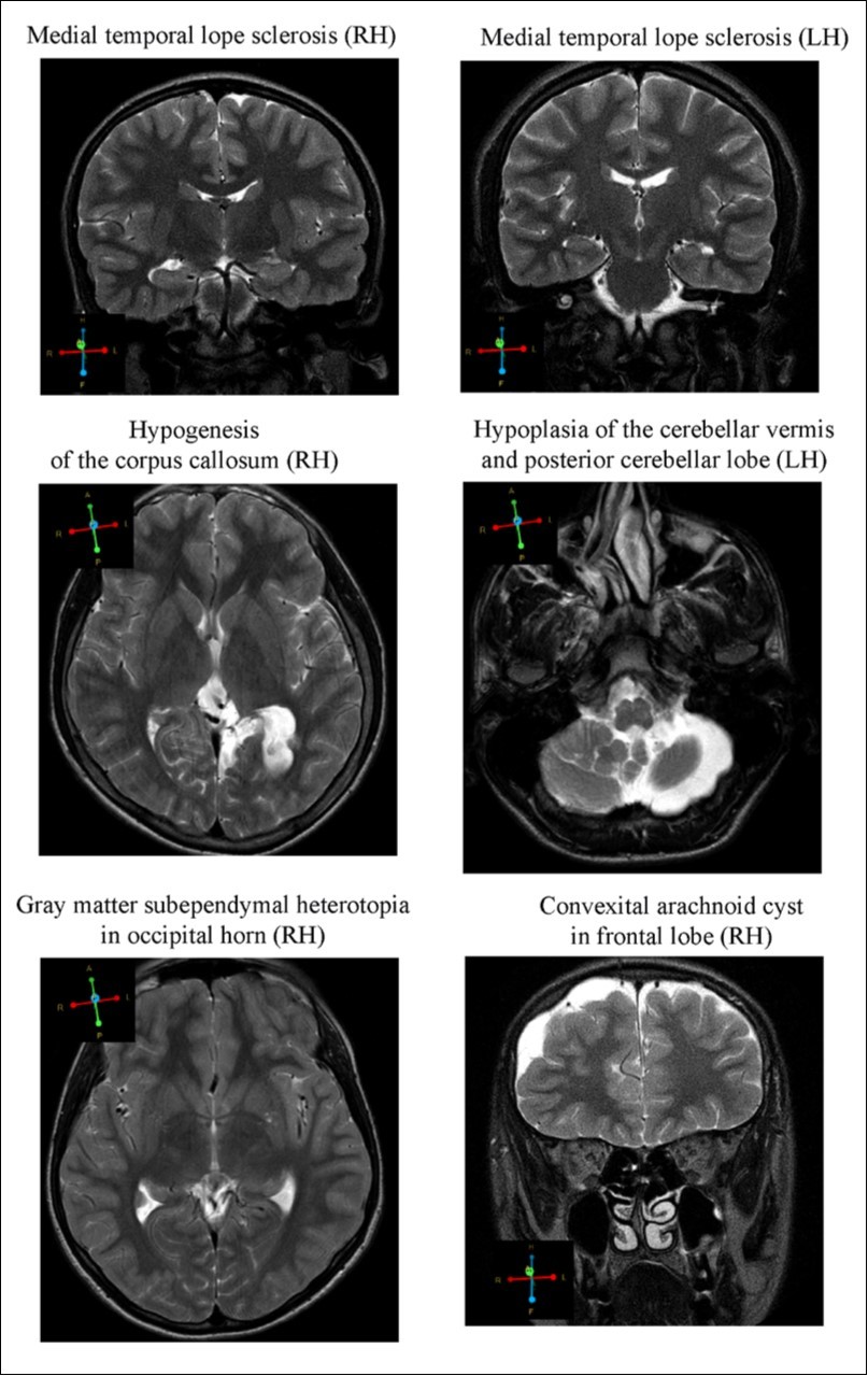  Representative images of the brain abnormalities observed in some children with the tendency of antisocial behavior (AST) by Magnetic Resonance Imaging (MRI). Coronal sections (4 mm thick) were acquired by T2 turpbo spin echo (TSE) multi vane (MV) sequence; Axial sections (6mm thick) - T2 TSE.