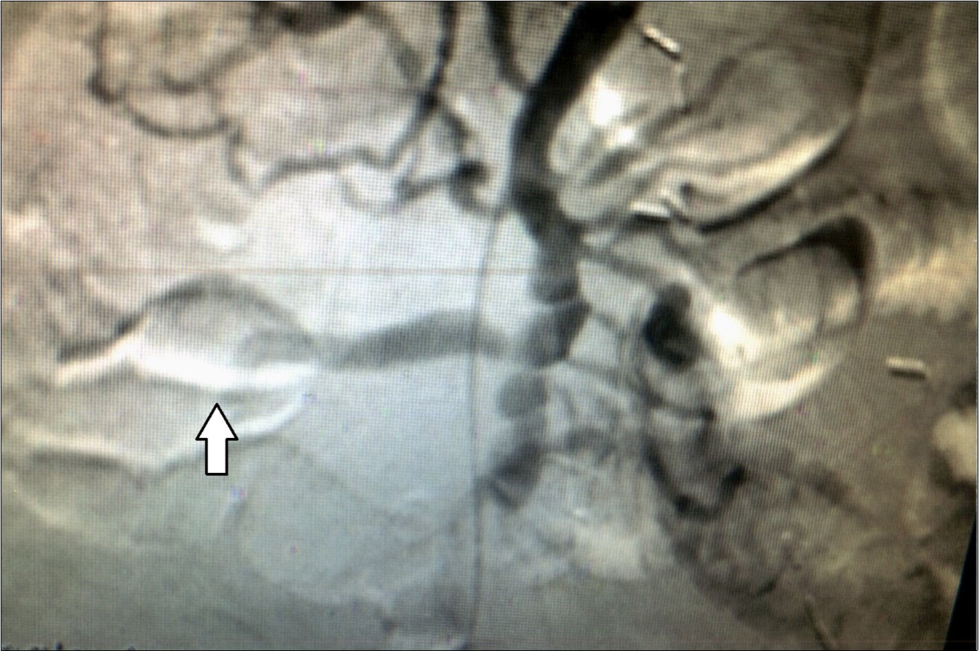  Case 2 – Superior Mesenteric Artery Branch Aneurysm.