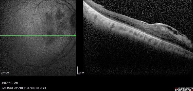  4 years Post-SOR SD-OCT image of a 42-year-old patient with BCVA 6/12 after anatomical repair of a macula-on GRT with PPV + SOI with preoperative BCVA 6/18. We can, notice the presence ERM and CME.