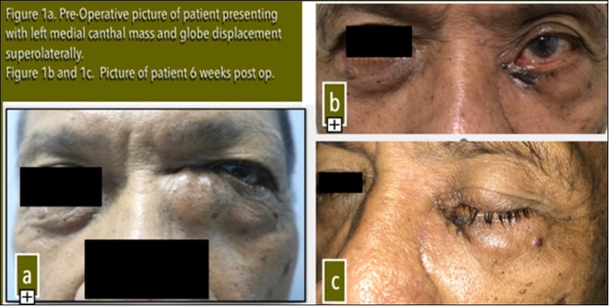  Pre-Operative picture of patient presenting with left medial canthal mass and globe displacement superolaterally. Figure 1b and 1c. Picture of patient 6 weeks post op.