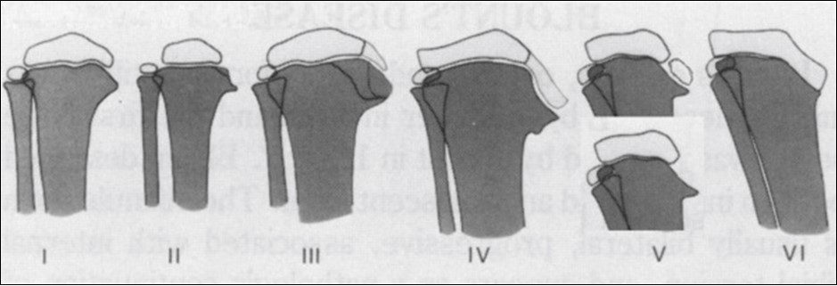  Langenskiold staging describes six radiographic stages of the disease based on the degree of epiphyseal depression and metaphyseal fragmentation of the proximal medial tibial epiphysis 13.