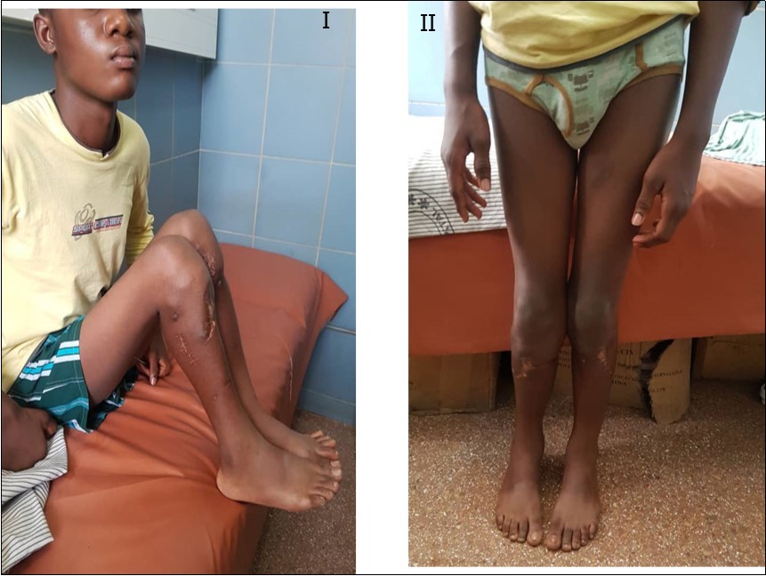  A photograph of the patient, 2 years post-operatively, sitting on a couch with knees flexed, I, and standing on the floor, II, showing correction of varus and torsional deformities of the tibiae.
