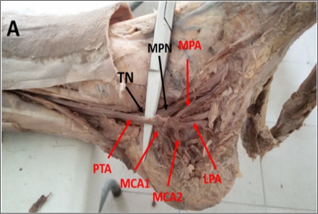  Photograph of the left ankle region showing double              medial calcaneal arteries (MCAs) branching from the posterior   tibial artery (PTA). MPA: Medial plantar artery, LPA: lateral plantar artery, TN: tibial nerve, MPN: medial plantar nerve.