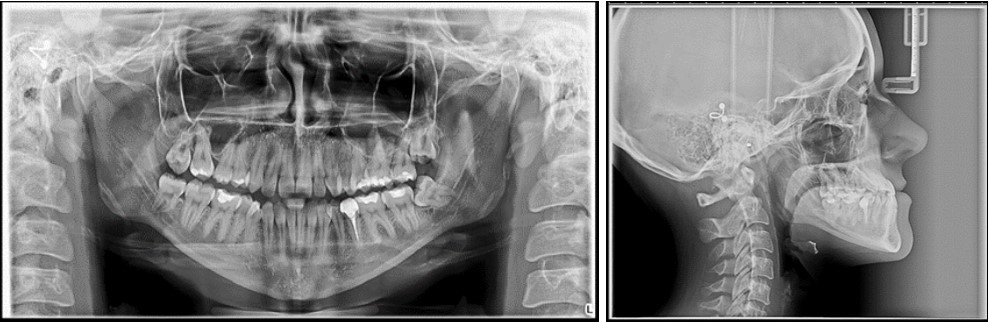  Initial panoramic and  lateral cephalometric radiographs