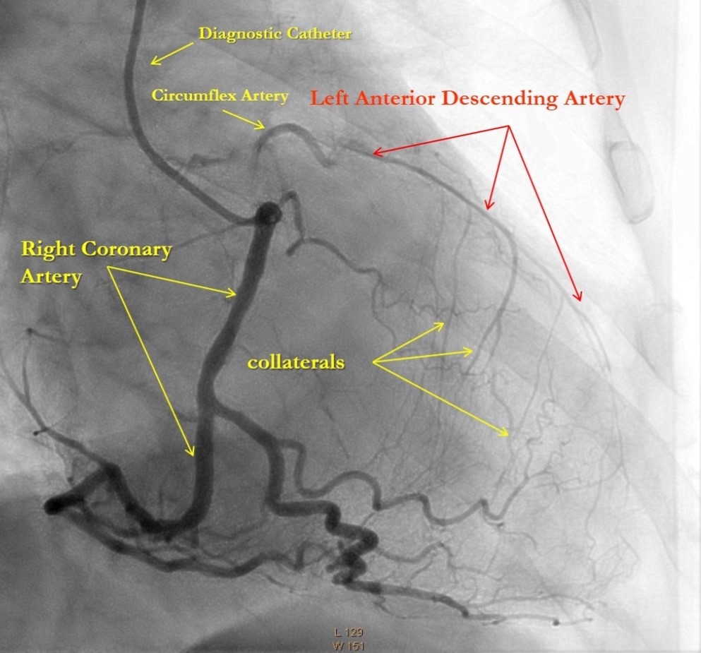   Right Coronary Artery with developed right-to-left collaterals.