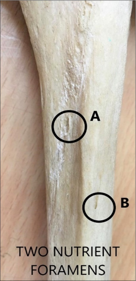  showing two nutrient foramina on shaft of tibia