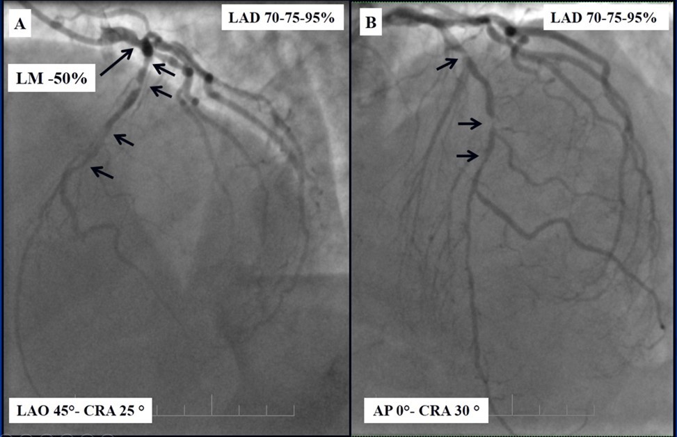  A - 50% stenosis of the distal segment of the LMCA; B - 70-75-95% stenosis in mid-segment of the LAD. 