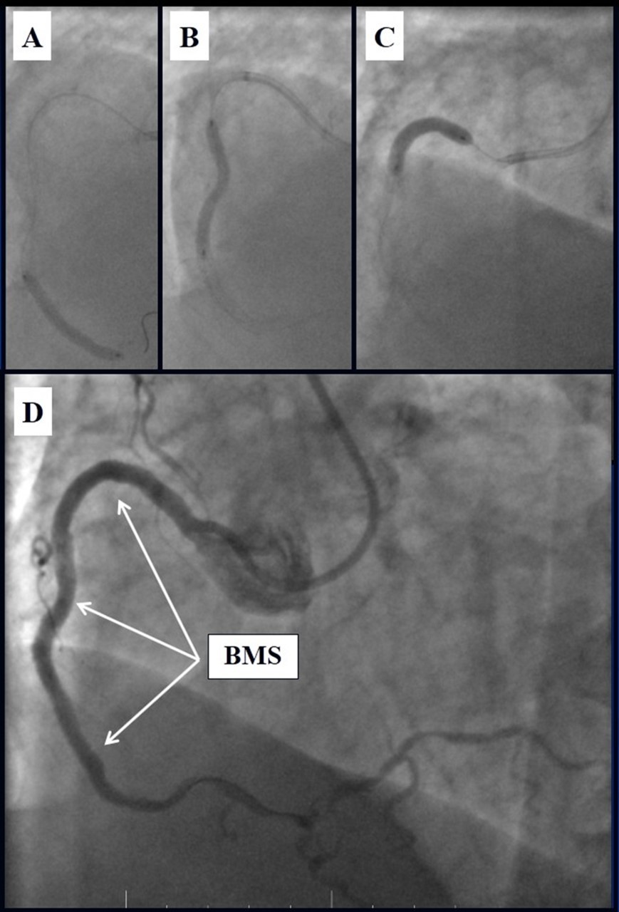  A, B, C - Stenting of the RCA with BMS; D - Angiography result.