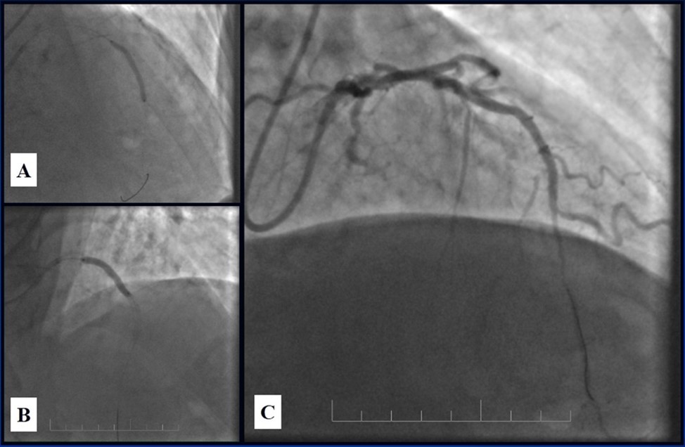  A, B - Stenting of the LAD with DES; C - Angiography result.