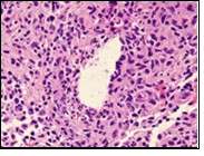  Granulomatous mastitis with              disseminated epitheloid cells admixed with neutrophils, lymphocytes and plasma cells 16.