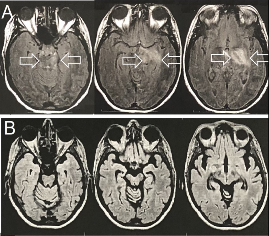 Brain Axial-FLAIR-MRI- (A) Expansive mass lesion with hyperintense signal in the left capsular nucleus region, with mesencephalic extension and enhancement by the paramagnetic agent (white arrows). (B) Complete improvement of the expansive mass lesion with the presence of brain atrophy.