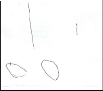  After treatment, the boy showed                                  improvement in his ability to hold the pen as could draw a more straight line