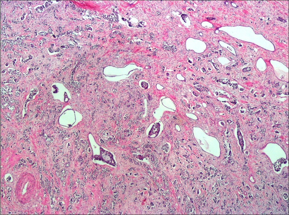  Infiltration of the tumor cells between prostatic ducts (H&E, x40)