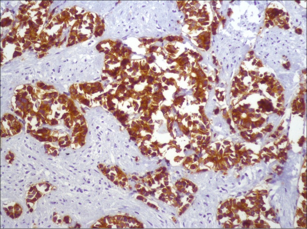  Diffusely and strong immunostaining for synaptophysin (Synaptophysin, x200)