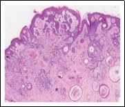  Desmoplastic trichoepithelioma               enunciating several horn cysts, nests of basaloid cells, an enveloping desmoplastic stroma and thinned out superimposed epithelium 12.