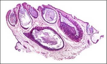  Nevus comedonicus with plugging of follicular ostia, keratinous impaction and a lining of hyperkeratotic stratified squamous epithelium11. 
