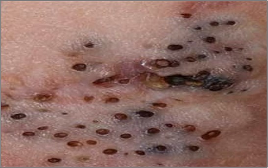  Nevus comedonicus clinically demonstrating darkly-stained, grouped, distended, follicular ostia, plugged with keratin, demonstrating a honey-comb pattern14.