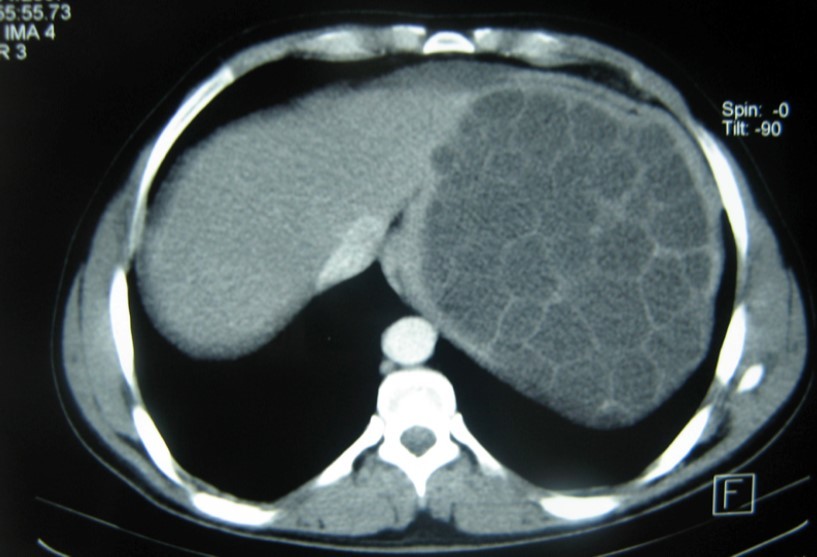  CT showing a huge single 20×16×18cm cystic mass located in the spleen